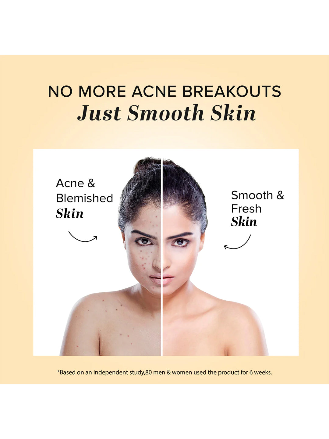 Khadi Natural Acne Pimple Cream (50g)