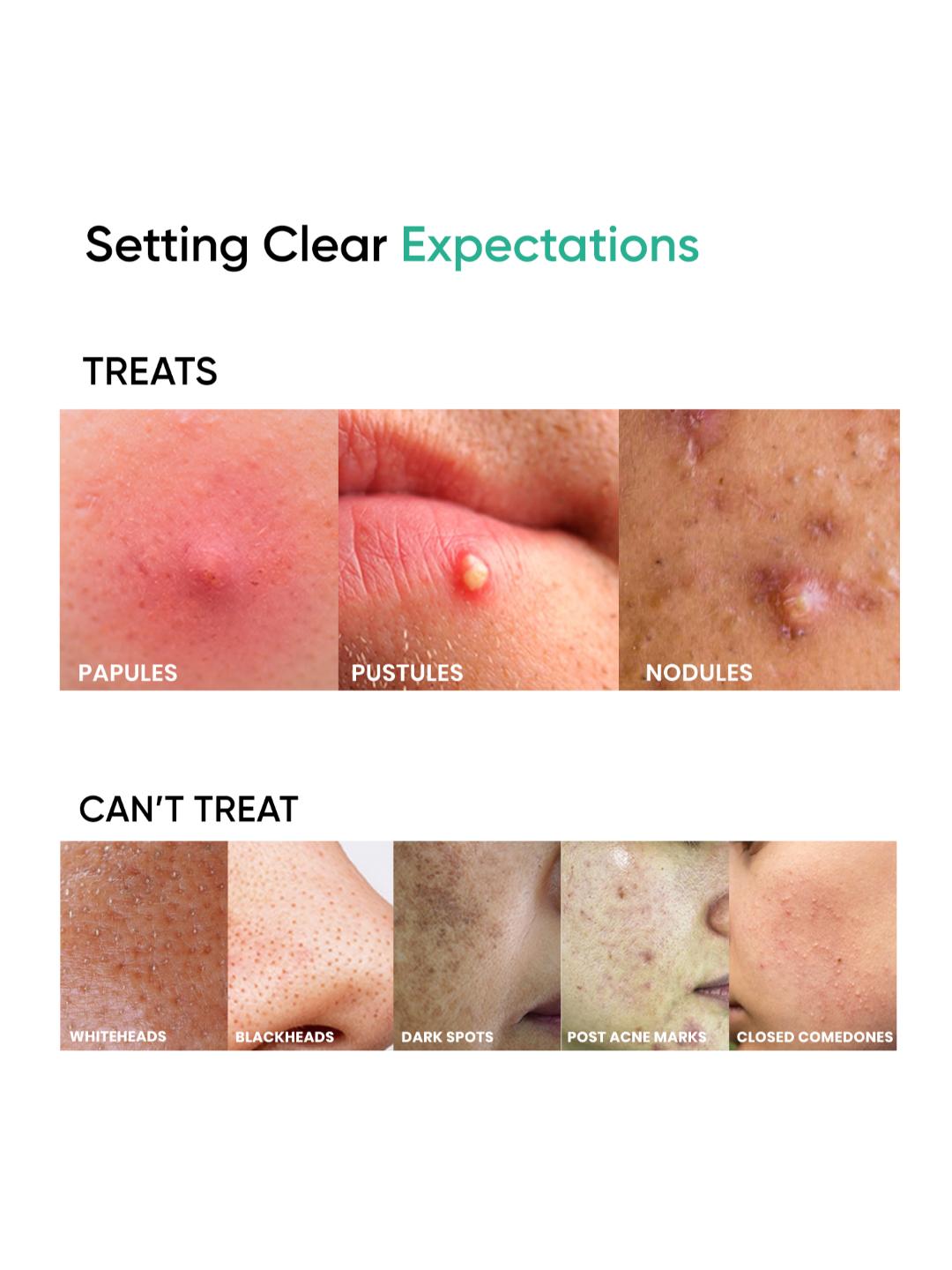 SkinInspired AcNil3 Acne Spot Corrector (12 ml)